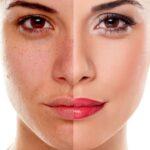 peeling-profundo peeling-profundo